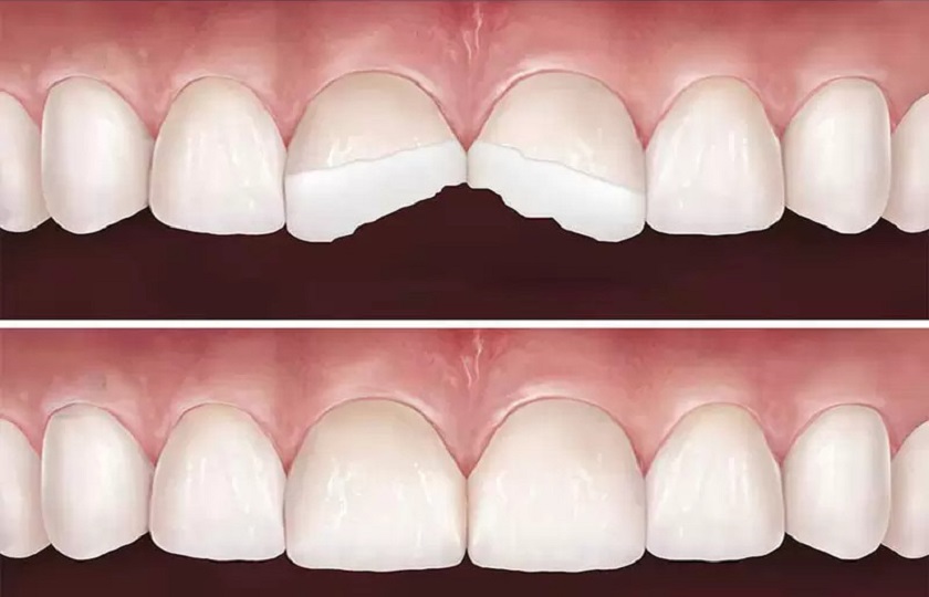 Bọc sứ răng cửa khắc phục tình trạng răng sứt mẻ, gãy vỡ
