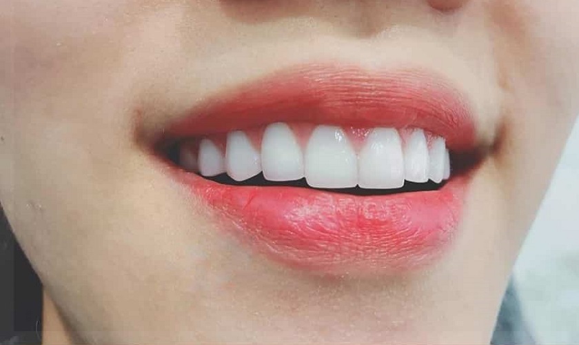 Khi nào không nên bọc sứ răng cửa?