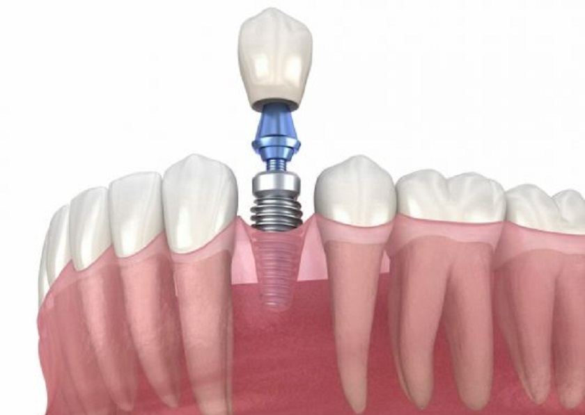 Kỹ thuật trồng răng sứ trên Implant
