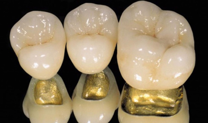 Răng sứ kim loại quý