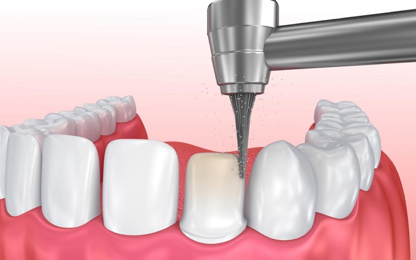 Mài cùi răng thật để tạo thành trụ răng