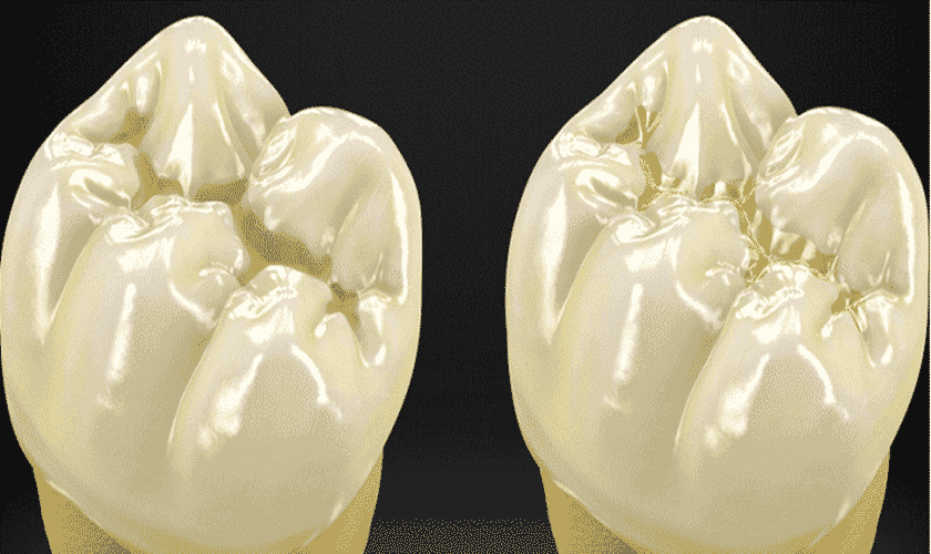 Cách nhận biết răng sứ Titan bằng mắt thường