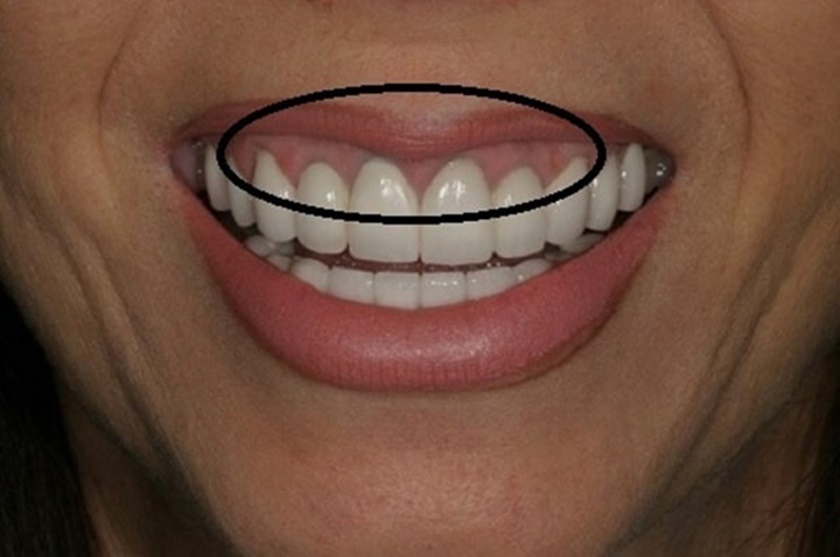 Quan sát kỹ, ta sẽ phát hiện răng sứ Titan phần đường viền nướu có màu thâm đen