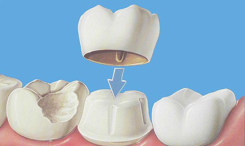 Nếu khách hàng lo lắng bọc răng sứ có tốt không, nha khoa Nhân Tâm xin trả lời là tốt.