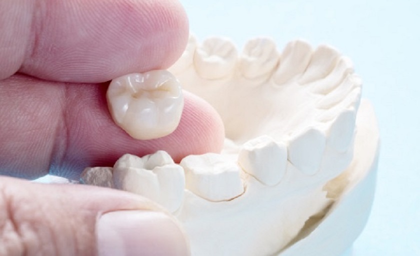 Bảng giá răng sứ không kim loại hiện nay như thế nào?