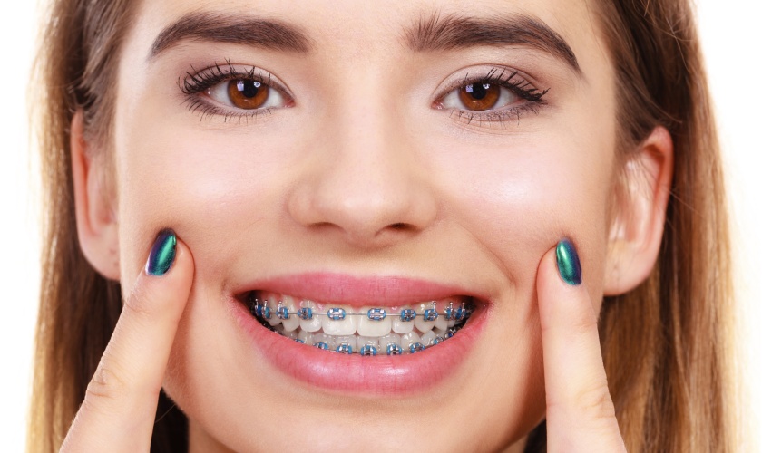 Niềng răng là phương pháp chỉnh răng mọc lệch được nhiều người nhắc đến