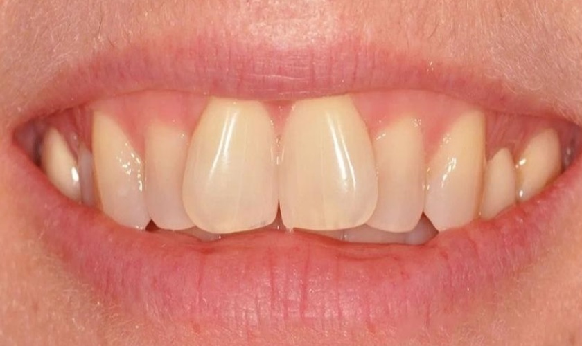 Trường hợp răng mọc lệch nhẹ có thể lựa chọn bọc răng sứ