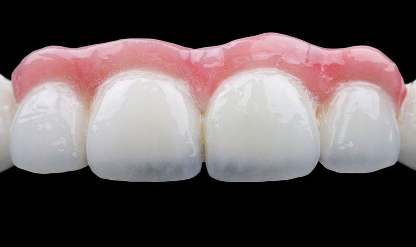 Nếu khách hàng thắc mắc có nên bọc răng sứ 2 răng cửa không, chúng ta cần xem xét đến những ưu điểm của bọc răng sứ 2 răng cửa