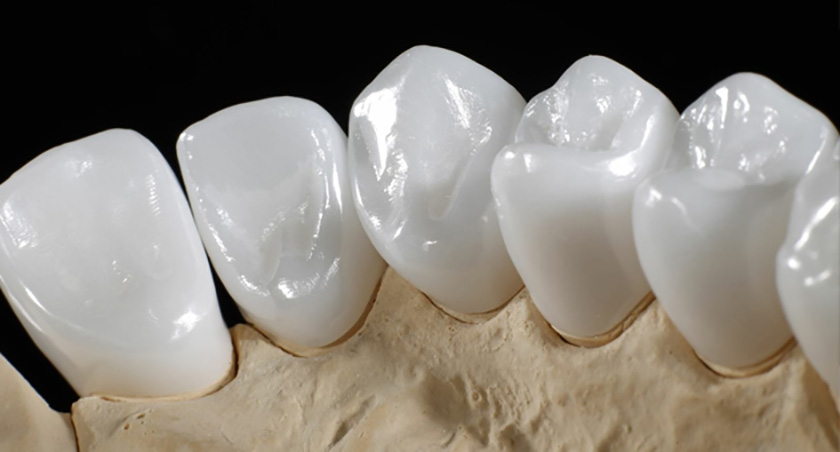 Bọc răng sứ Zirconia là phương pháp chăm sóc răng miệng được rất nhiều khách hàng tin dùng