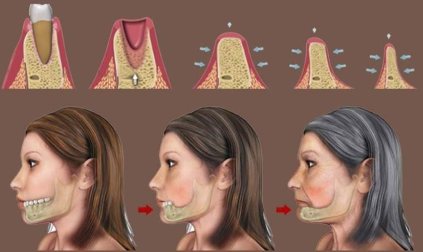 Cầu răng sứ không thể ngăn được tình trạng tiêu xương hàm