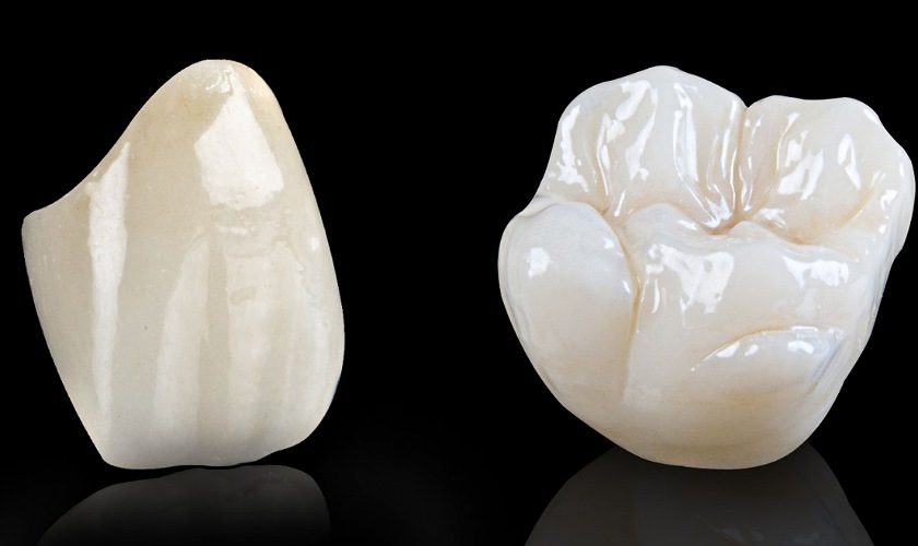 Răng sứ Cercon cần màu sắc như răng thật có màu sắc, hình dáng có hình dáng như răng thật