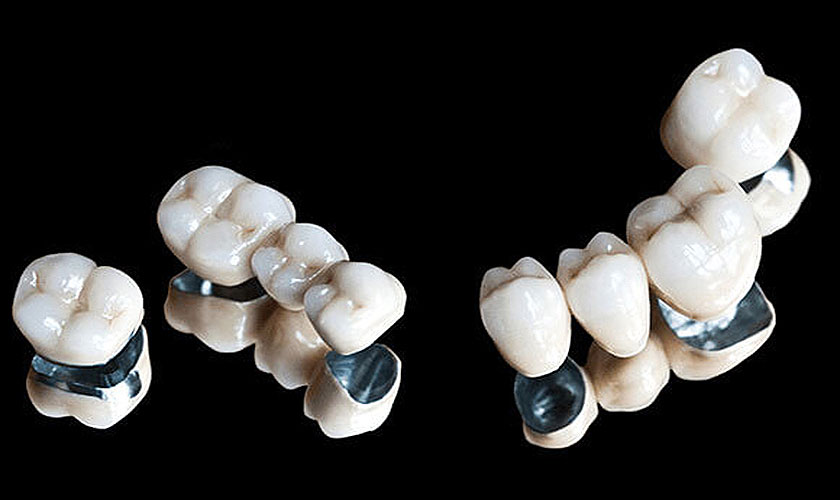 Nếu quý khách hàng băn khoăn trồng răng sứ titan ở đâu tốt Sài Gòn, hãy đến trồng răng sứ Titan nha khoa Nhân Tâm