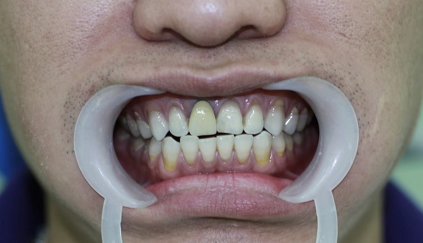 Răng tian làm đen viền nướu sau một thời gian sử dụng