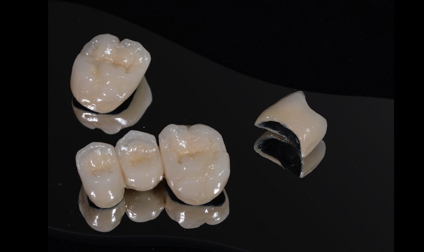 Có nên trồng răng titan và chi phí trồng răng bao nhiêu