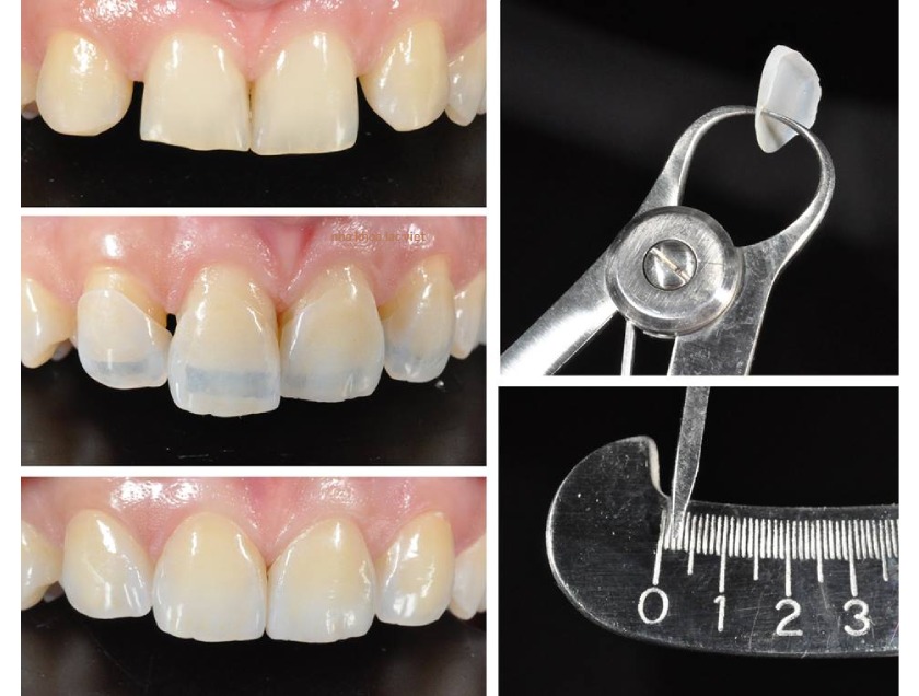 Mặt dán sứ sở hữu những ưu điểm vượt trội