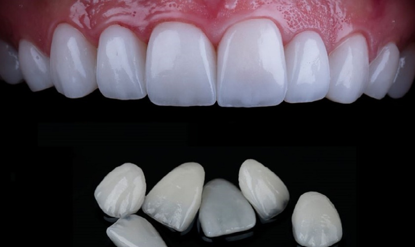 Mặt dán sứ đòi hỏi kỹ thuật cao