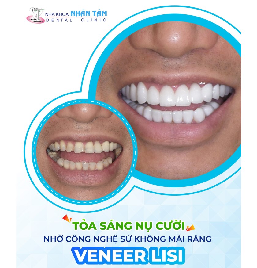 Khách hàng dán răng sứ tại Nha khoa Nhân Tâm