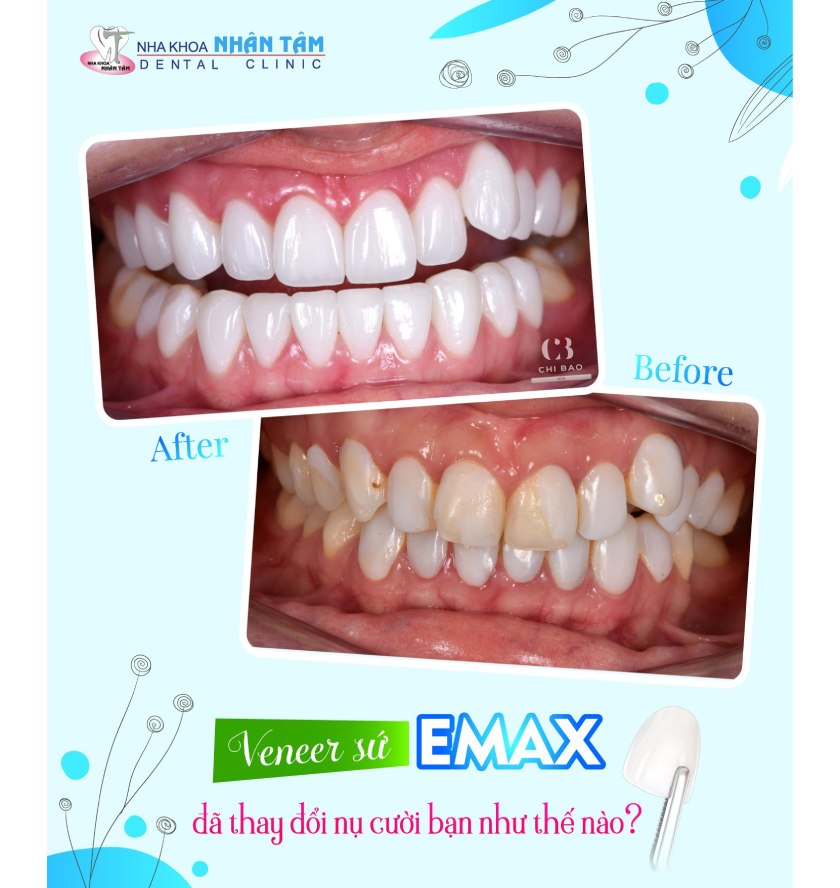 Khách hàng dán răng sứ tại Nha khoa Nhân Tâm