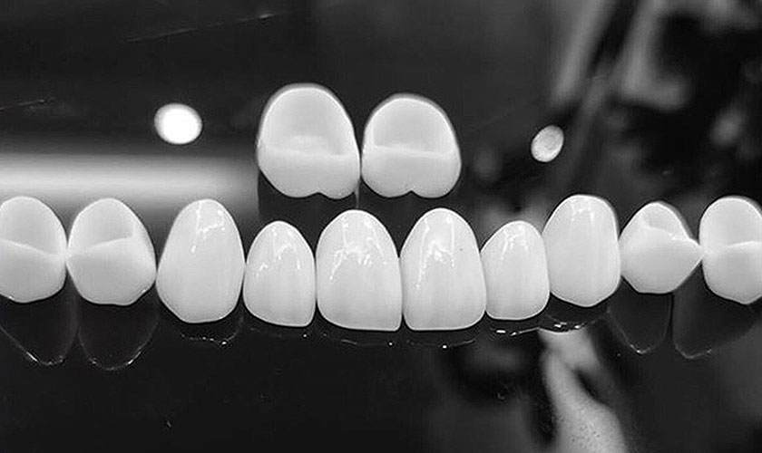 Bài viết vừa rồi đã giải đáp thắc mắc có nên bọc răng sứ Zirconia không