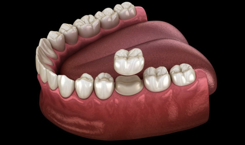 Bọc răng sứ là giải pháp được nhiều người lựa chọn Bọc răng sứ là giải pháp được nhiều người lựa chọn