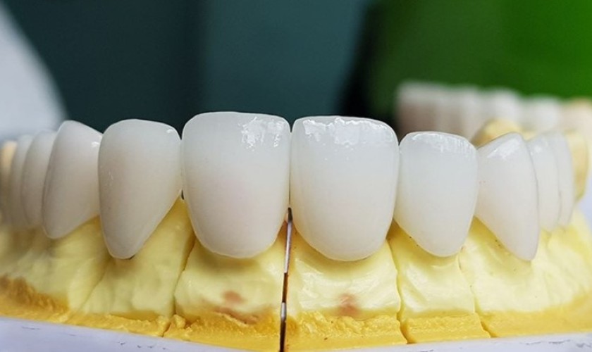 Răng toàn sứ Zirconia có tính thẩm mỹ cao