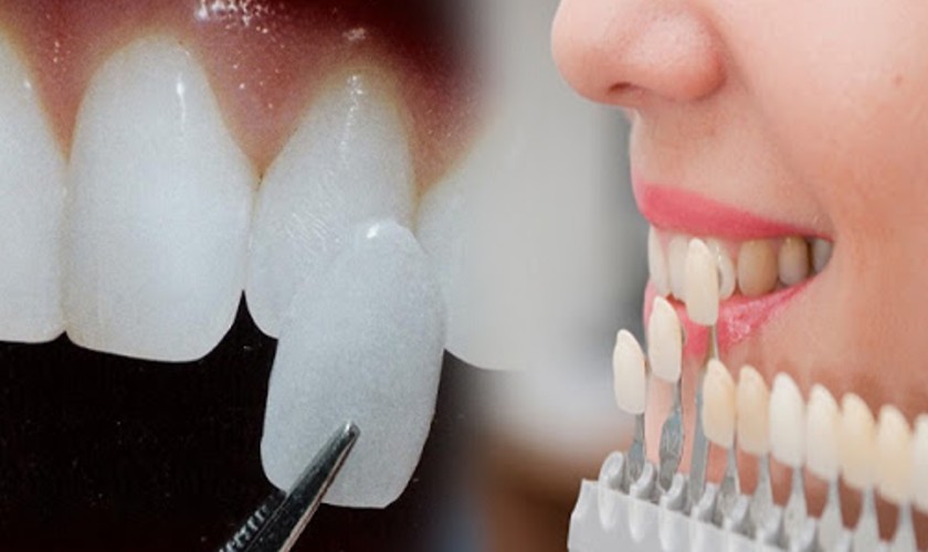 Răng toàn sứ Zirconia là giải pháp phục hình răng được ưa chuộng