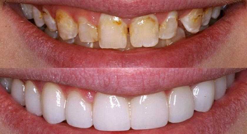 Răng sứ thẩm mỹ giúp khắc phục tình trạng răng ngả màu