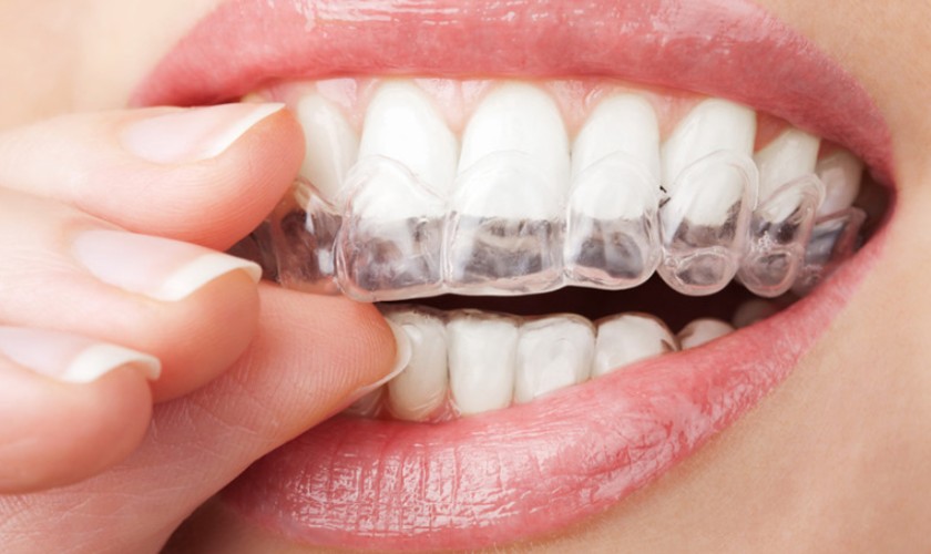 Bọc răng sứ tại nha khoa Nhân Tâm