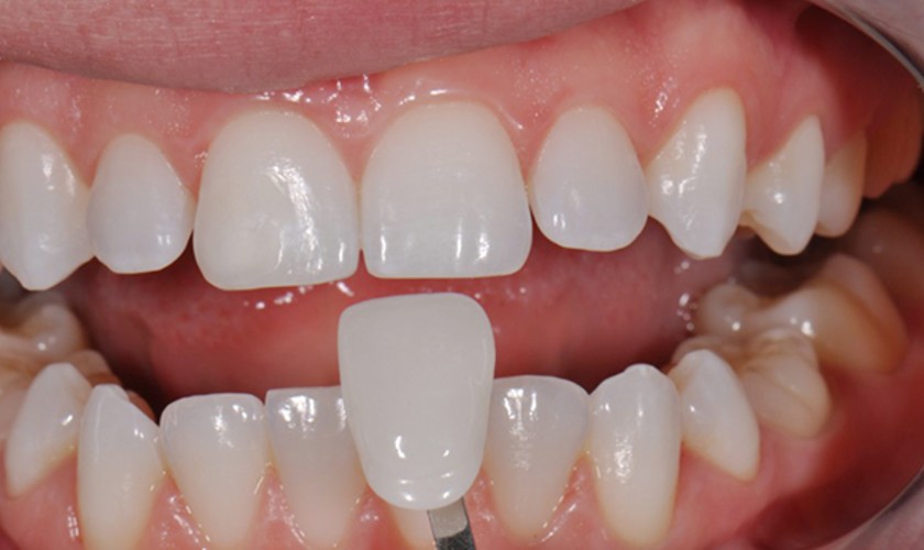 Bọc răng sứ là giải pháp được ưa chuộng hiện nay