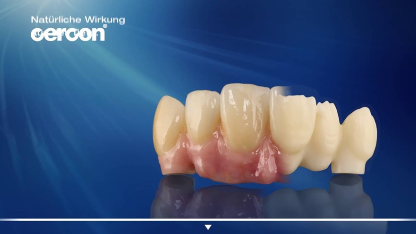 Răng sứ Cercon rất giống răng thật