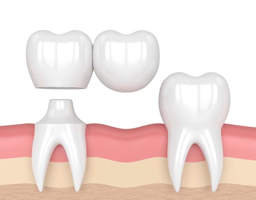 Cầu răng sứ nhảy