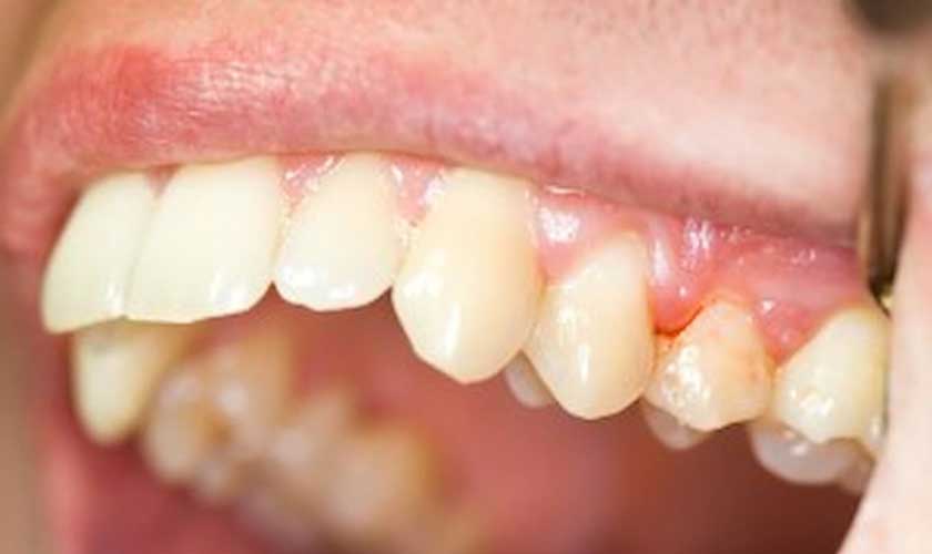 Viêm nướu răng bọc sứ có thể do mão răng sứ hoặc các nguyên nhân khác