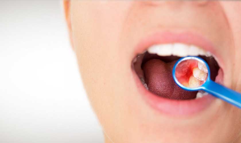 Viêm nướu khiến nướu răng bị sưng đỏ và gây đau cho bệnh nhân