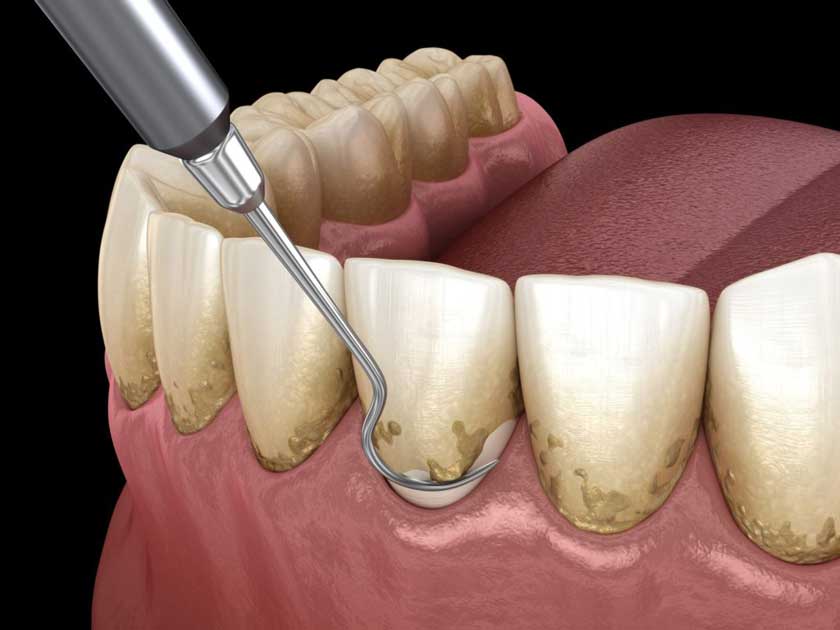 Cạo vôi răng định kỳ 6 tháng/ lần sẽ giúp phòng ngừa viêm nướu hiệu quả