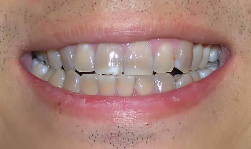 Làm răng sứ giá bao nhiêu sẽ tùy thuộc vào loại răng sứ mà bạn lựa chọn