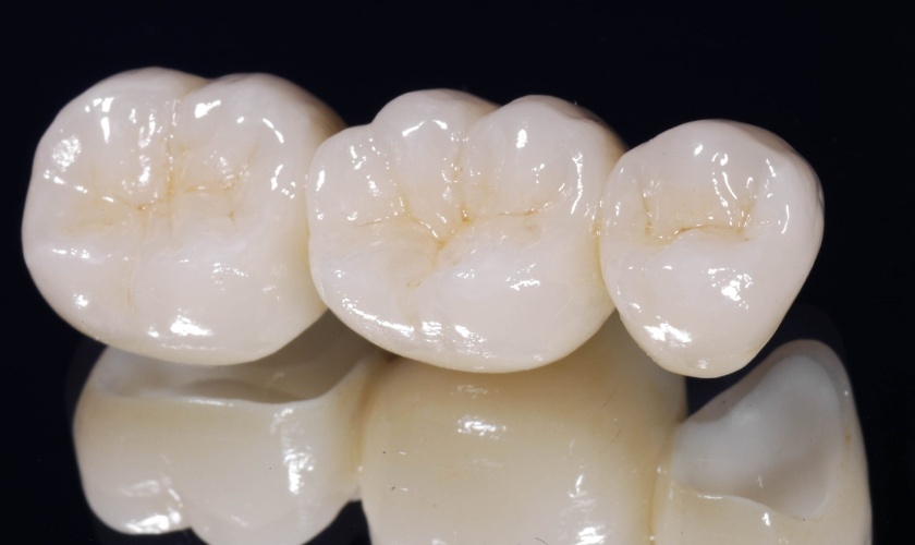 Nên thực hiện bọc răng sứ tại địa chỉ nha khoa uy tín