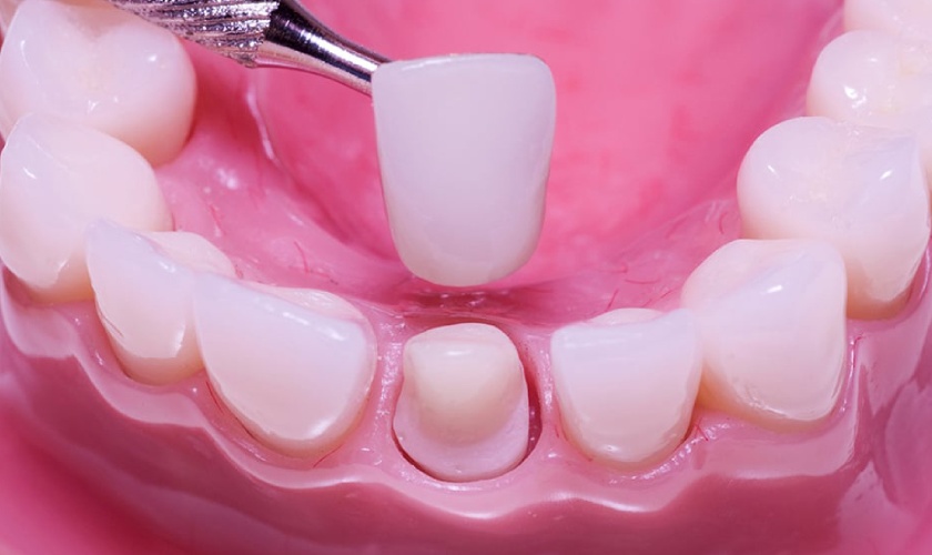 Làm răng sứ có đau không là thắc mắc của rất nhiều khách hàng