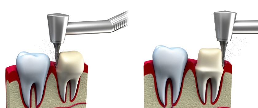 Cần thực hiện mài cùi răng đúng kỹ thuật để không gây cảm giác đau nhức
