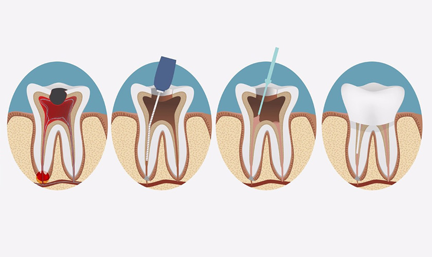 Răng bị viêm tủy cần điều trị tủy trước khi bọc răng sứ