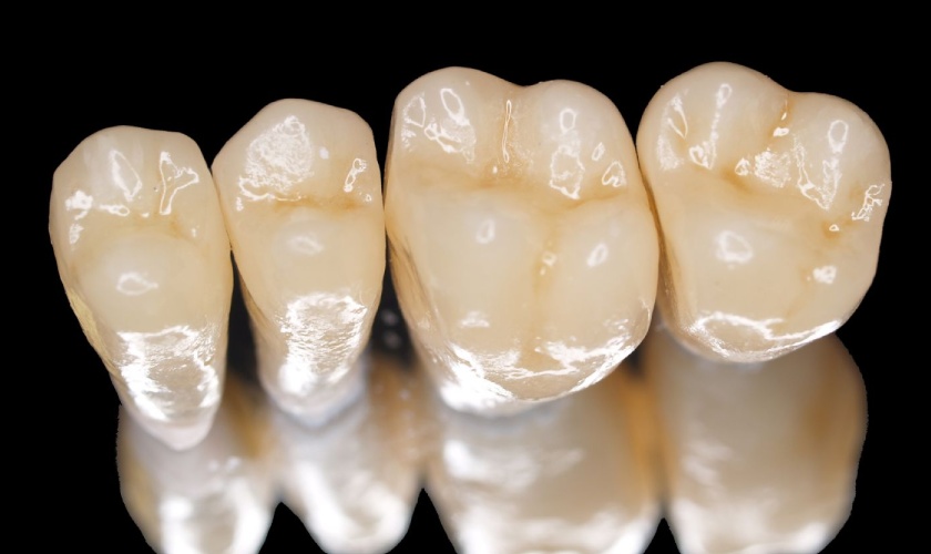 Mỗi loại răng sứ sẽ có mức giá khác nhau