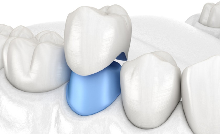 Làm răng sứ mất bao lâu phụ thuộc vào yếu tố nào?