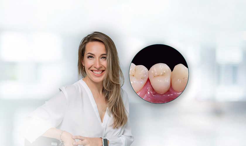 Răng sứ Vita được nhiều nước trên thế giới sử dụng