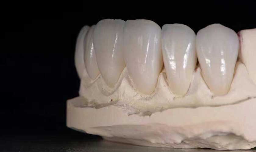 Răng sứ Vita có chi phí khoảng 4-5tr/ răng