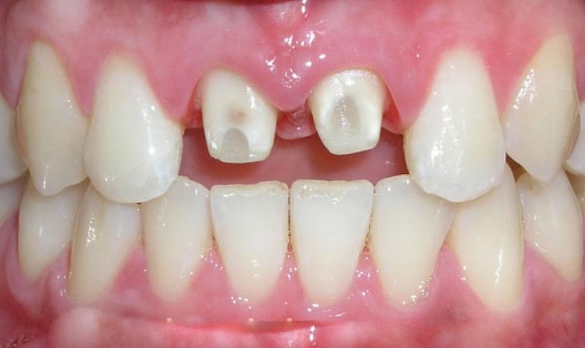 Vệ sinh răng miệng sạch sẽ sau khi làm răng sứ Titan