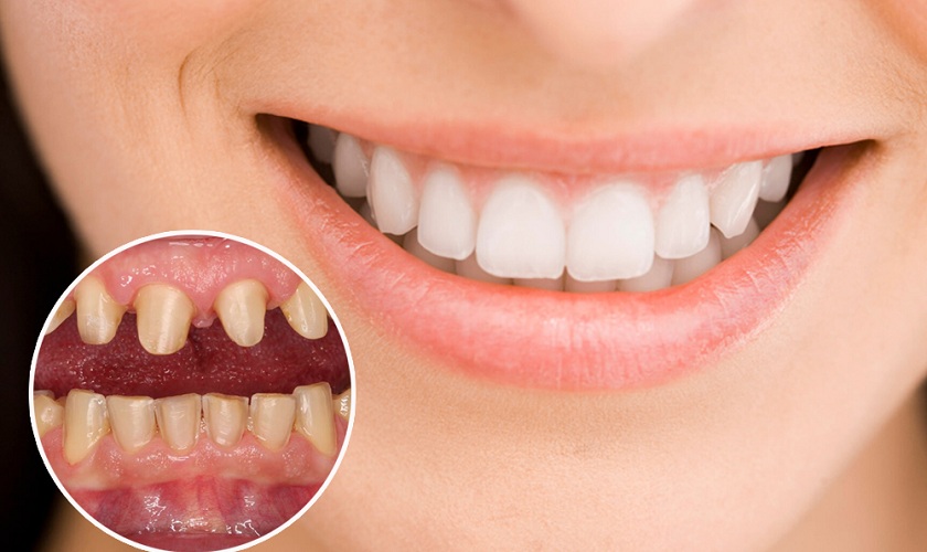 Làm răng sứ Titan là gì? Làm răng sứ Titan có tốt không?