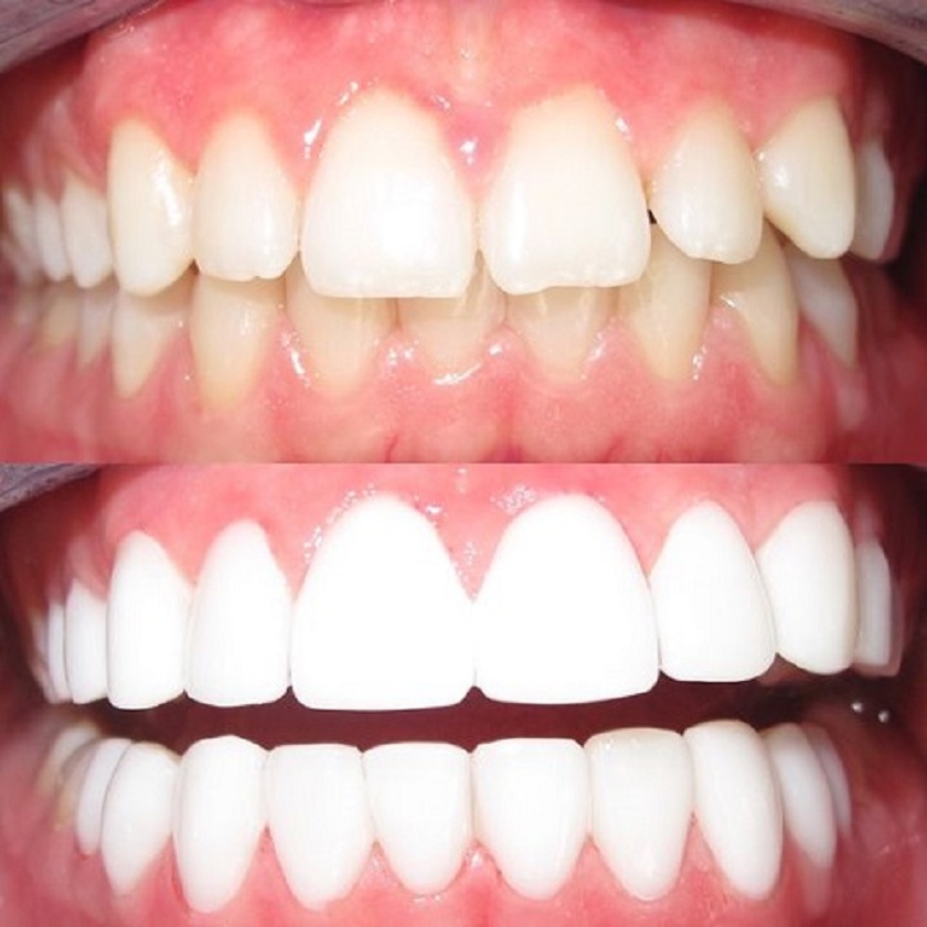 Tìm địa chỉ nha khoa uy tín để bọc răng sứ titan