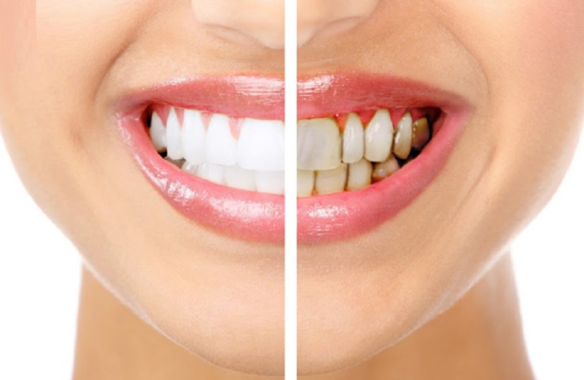 Bọc răng sứ giúp khắc phục tình trạng răng ố vàng, xỉn màu
