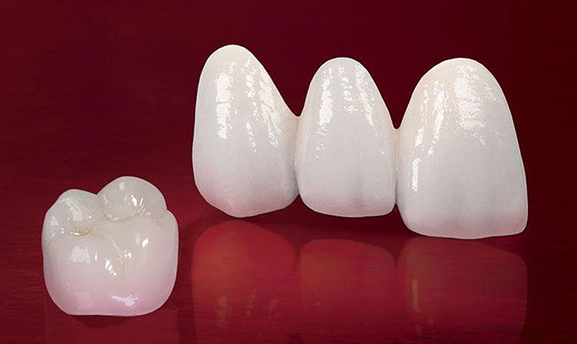 Trả lời cho câu hỏi làm răng sứ Zirconia mất bao lâu, để làm răng sứ Zirconia chỉ mất khoảng 1 tuần 