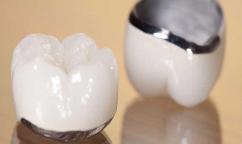 Răng sứ Titan cũng được khá nhiều người lựa chọn