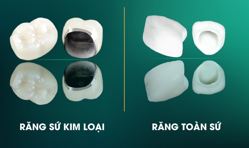 Răng toàn sứ được đánh giá cao hơn so với răng sứ kim loại